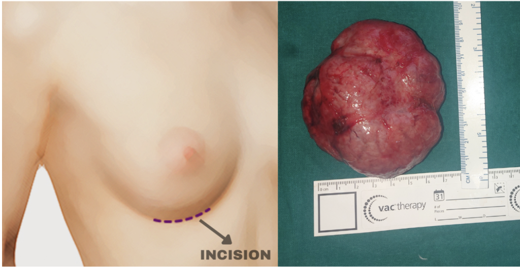 Breast Tumour